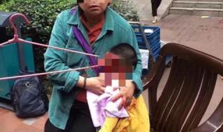 硬膜外血肿 硬膜外血肿